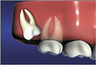 Mesial Impaction is the most common condition requiring extraction Wisdom Teeth Mesial Impaction